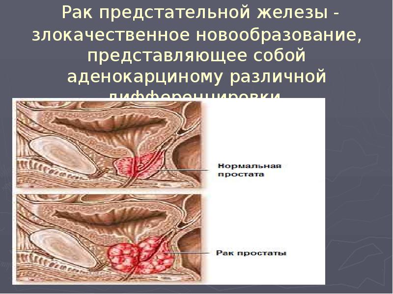 Рак предстательной железы - злокачественное новообразование, представляющее собой аденокарциному различной дифференцировки. Рак предстательной железы - злокачественное новообразование, представляющее собой аденокарциному различной дифференцировки.