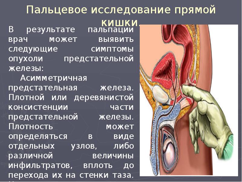 Пальцевое исследование прямой кишки. Пальцевое исследование прямой кишки.