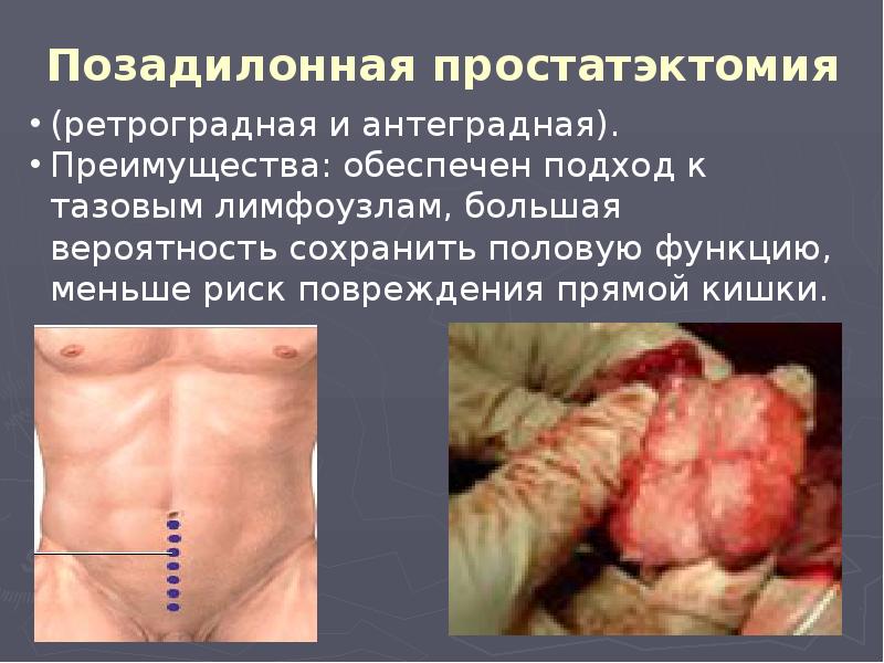 Позадилонная простатэктомия Позадилонная простатэктомия