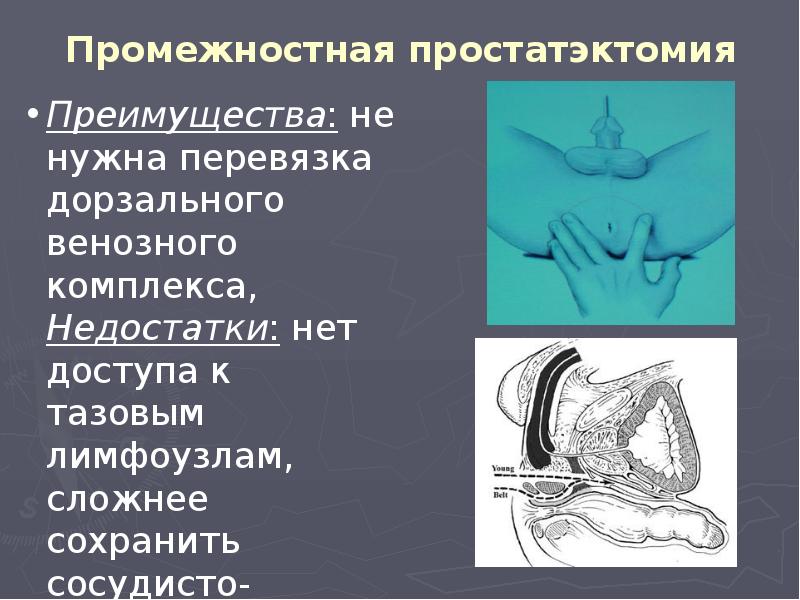 Промежностная простатэктомия Промежностная простатэктомия