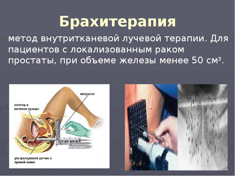 Брахитерапия Брахитерапия