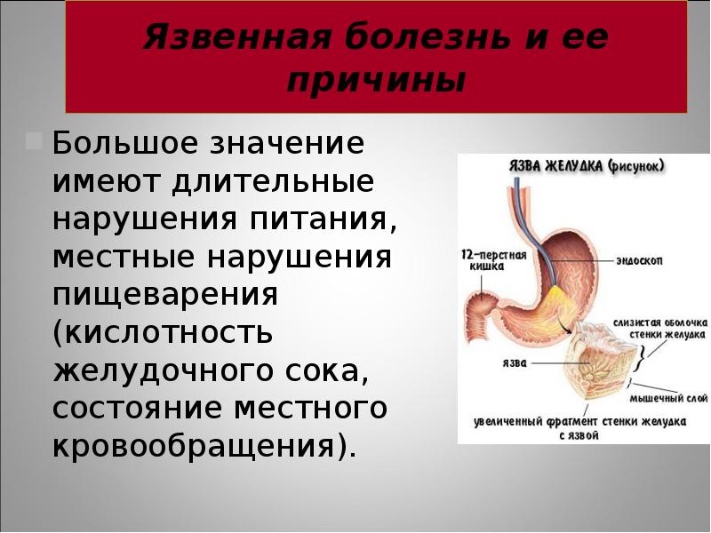 Презентация на тему язва желудка и двенадцатиперстной кишки