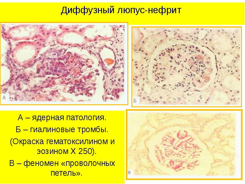 Аутоиммунные заболевания презентация