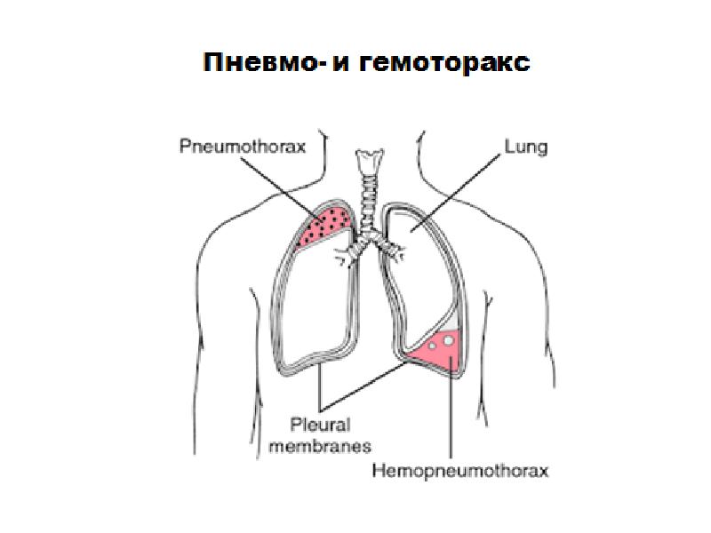 Презентация пневмоторакс и гемоторакс