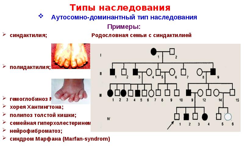 Тест типы наследования. Аутосомно-доминантный Тип наследования заболевания. Аутосомно-доминантный Тип наследования синдактилия. 3. Аутосомно – доминантный Тип наследования. Аутосомно-доминантный Тип наследования заболевания примеры.