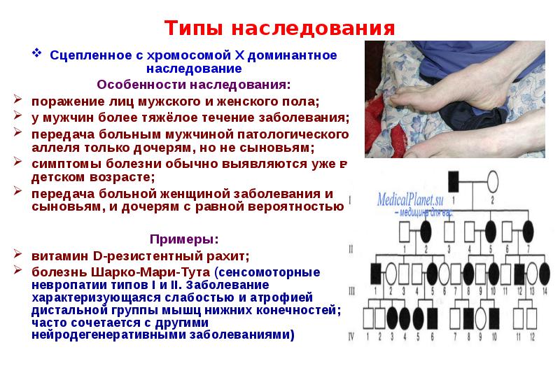 Сцеплен с х хромосомой доминантный