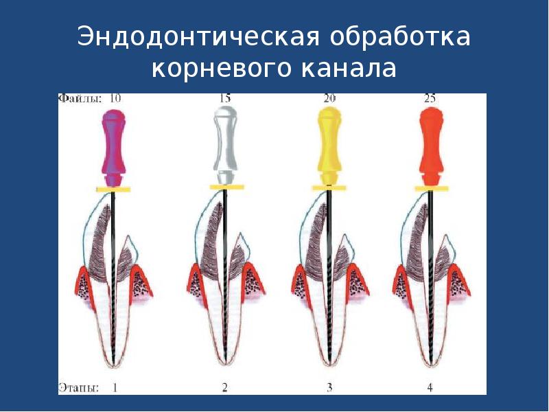 Эндодонтические аксессуары презентация