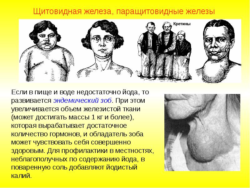 Гормоны щитовидной и паращитовидных желез. Гиперфункция эндокринной железы. Эндемический зоб гормоны. Гипо и гиперфункция щитовидной железы. Эндемический зоб презентация.