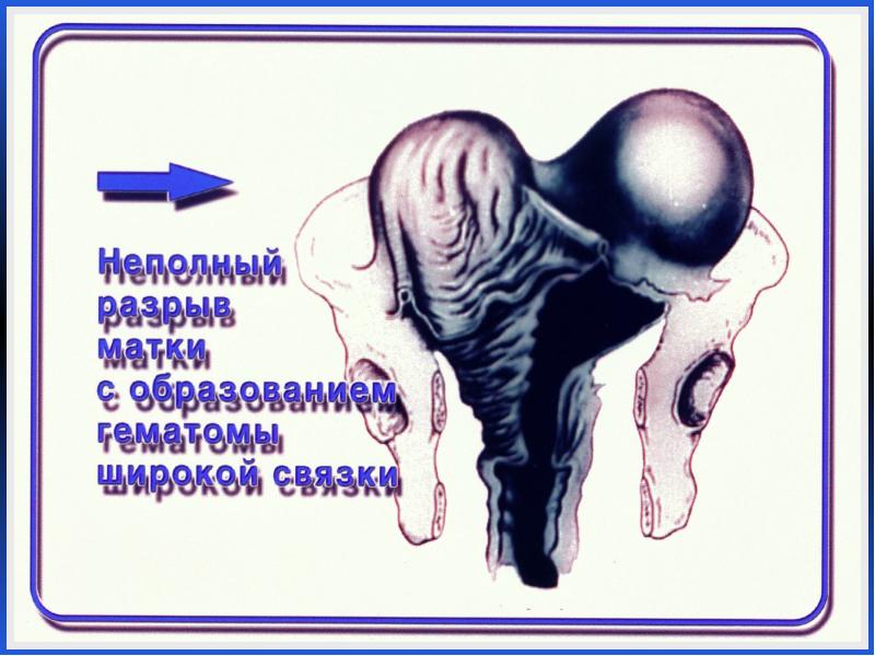 Разрыв матки презентация по акушерству