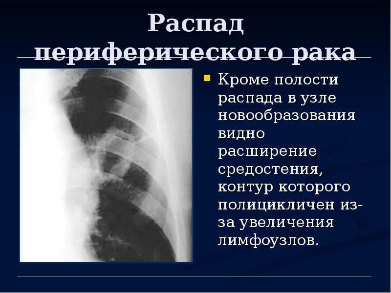 Лучевая диагностика органов средостения презентация