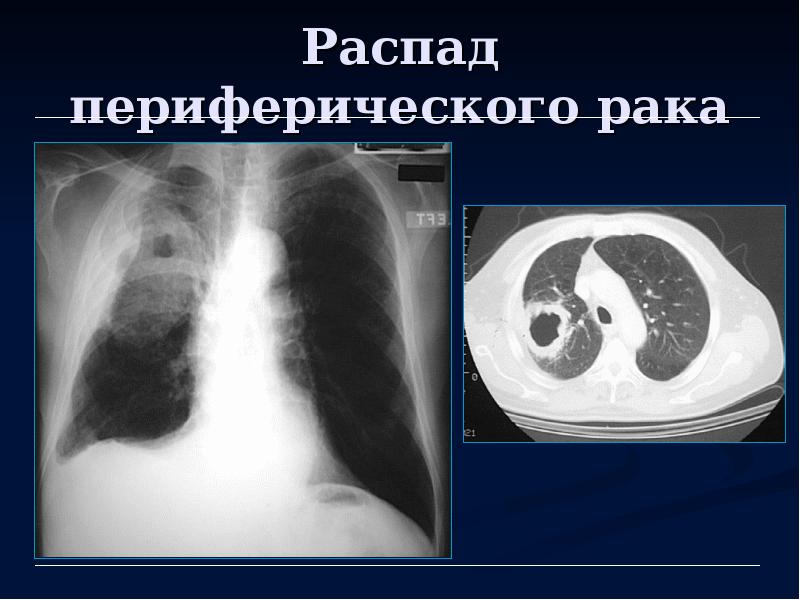 Лучевая диагностика рака легкого презентация