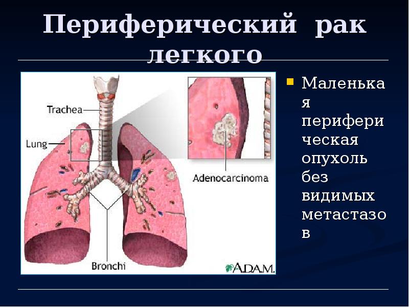 Центральный рак легкого презентация