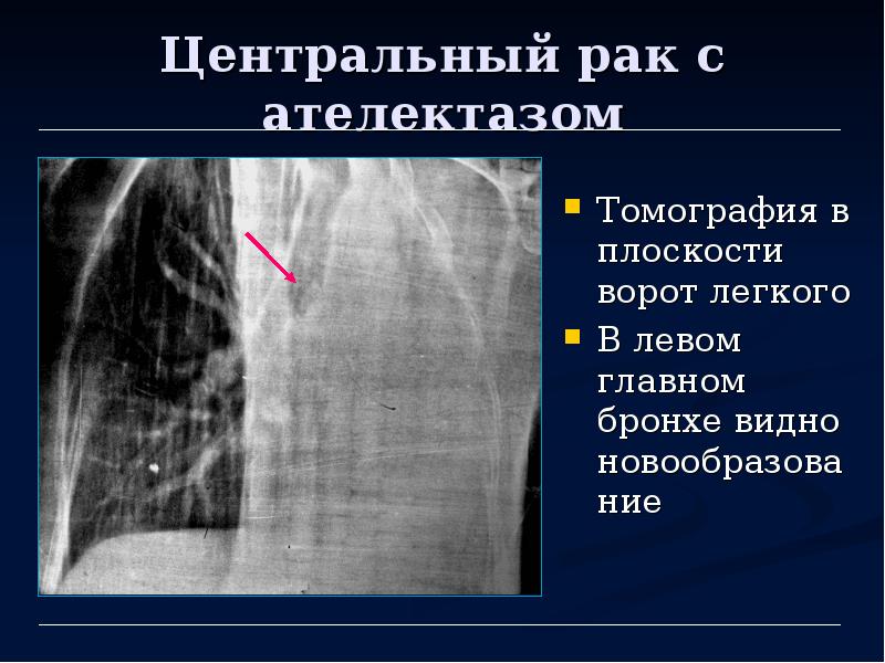 Лучевая диагностика рака легкого презентация