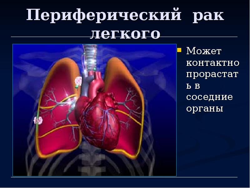 Диагноз периферический рак. Периферическое образование легкого. Периферическое образование.