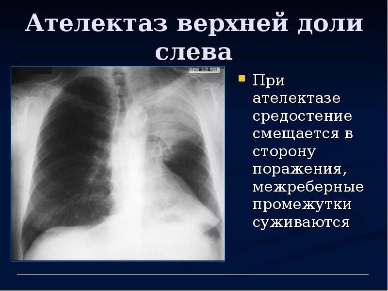 Лучевая диагностика средостения презентация