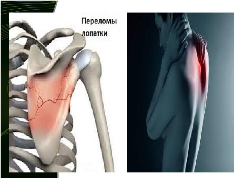 Презентация на тему переломы ключицы