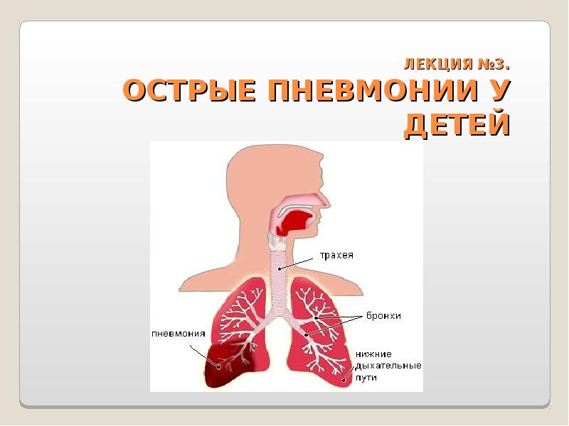 Острая пневмония у детей презентация