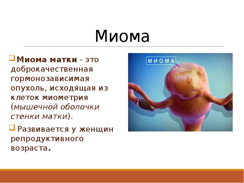 Миома матки это. Презентация на тему миома матки. Миома матки гинекология. Миома матки доброкачественная.