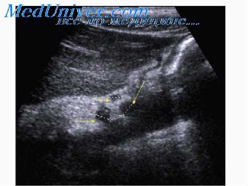 Как выглядят метастазы на узи фото