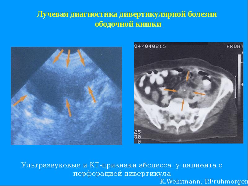 Лечение дивертикулярной болезни кишки. Дивертикулы ободочной кишки кт. Дивертикулярная ободочной кишки. Дивертикулёз сигмовидной кишки кт.