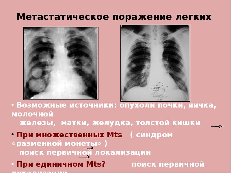 100 легких. Метастатическое поражение легких. 100 Процентное поражение легких.