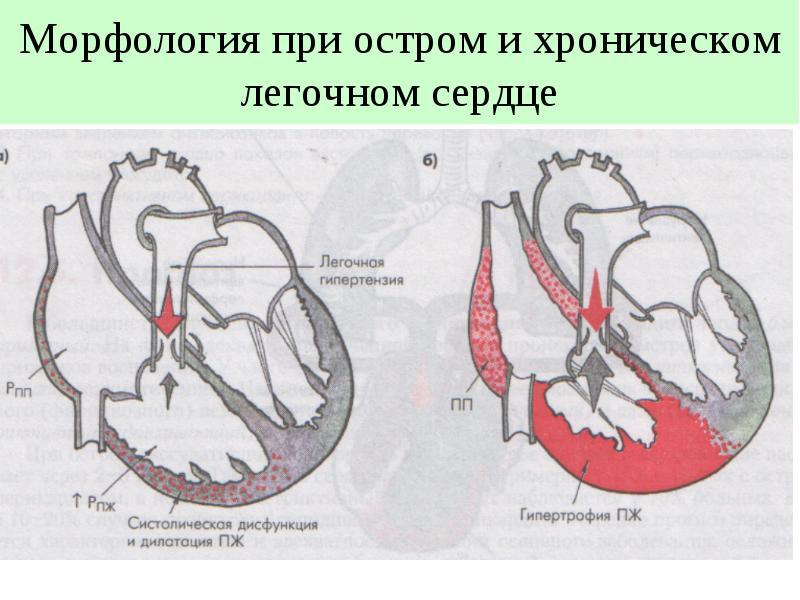 Легочное сердце картинки