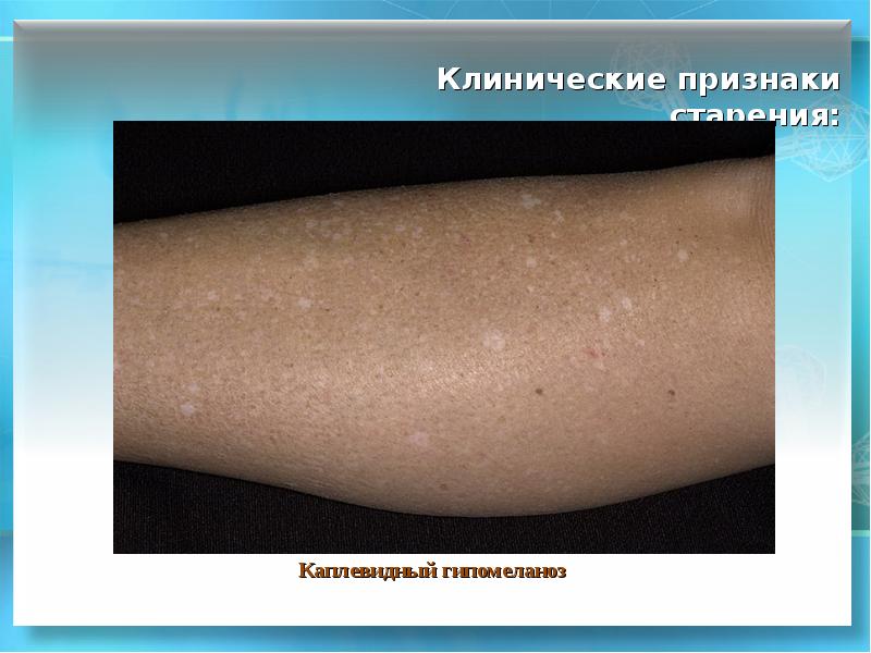 Гипомеланоз идиопатический каплевидный (русский язык) « Globale Dermatologie