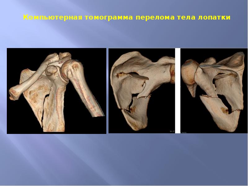 Перелом ключицы презентация