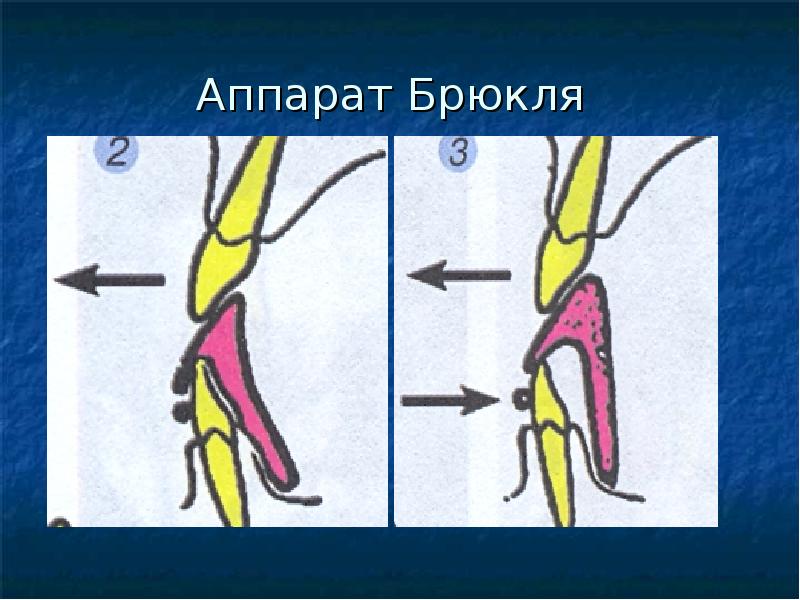 Аппарат брюкля фото