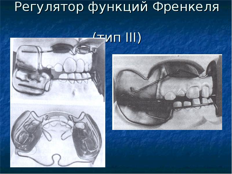 Мезиальная окклюзия презентация ортодонтия