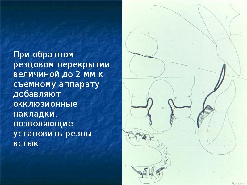 Резцовый. Обратная резцовая окклюзия. Обратное резцовое перекрытие. Мезиальная окклюзия презентация. Трансверзальная резцовая окклюзия.