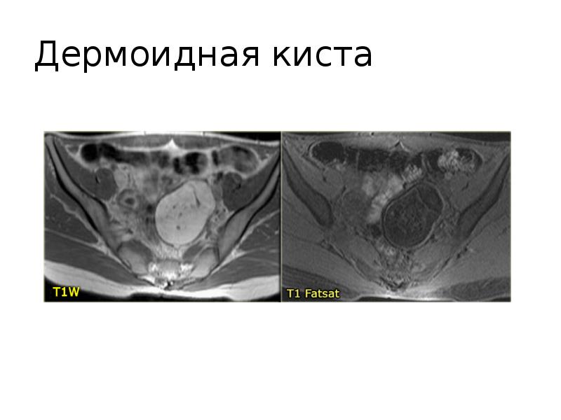 Цистаденома яичника мрт