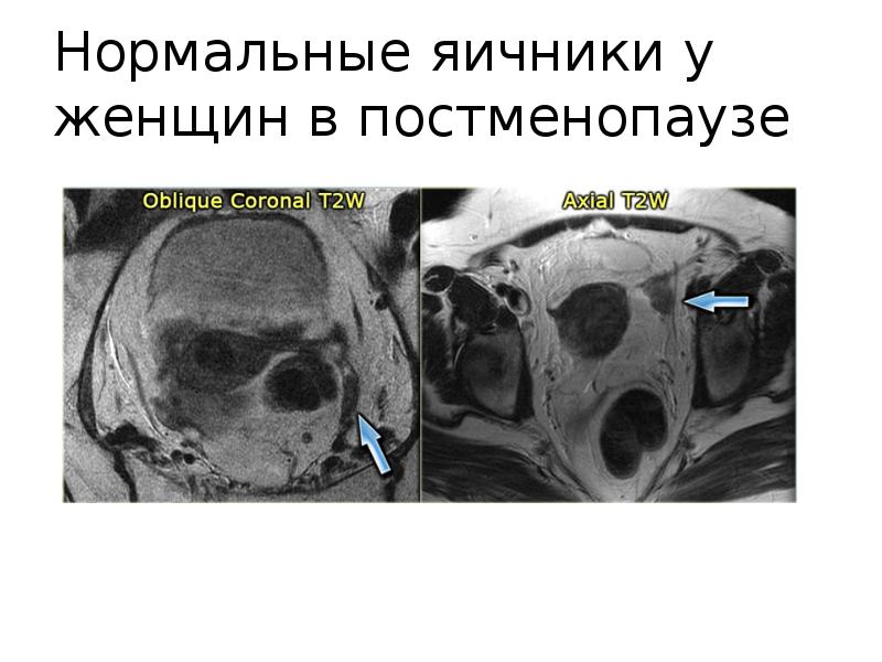 Поликистоз яичников мрт картина