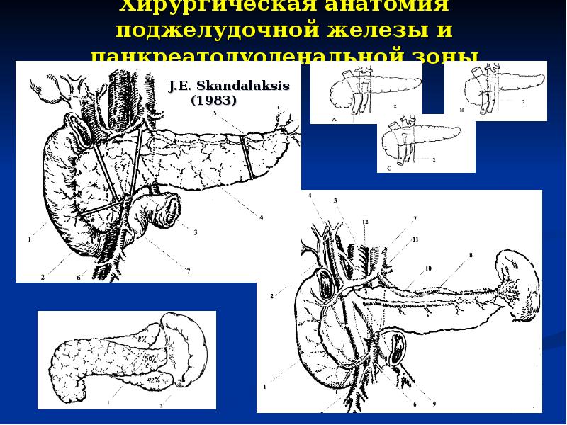 Схема операции. Панкреодуоденэктомия, панкреодуоденальная резекция. Гастропанкреатодуоденальная резекция поджелудочной железы. Панкреатодуоденальная резекция схема. Пилоросохраняющая панкреатодуоденальная резекция.