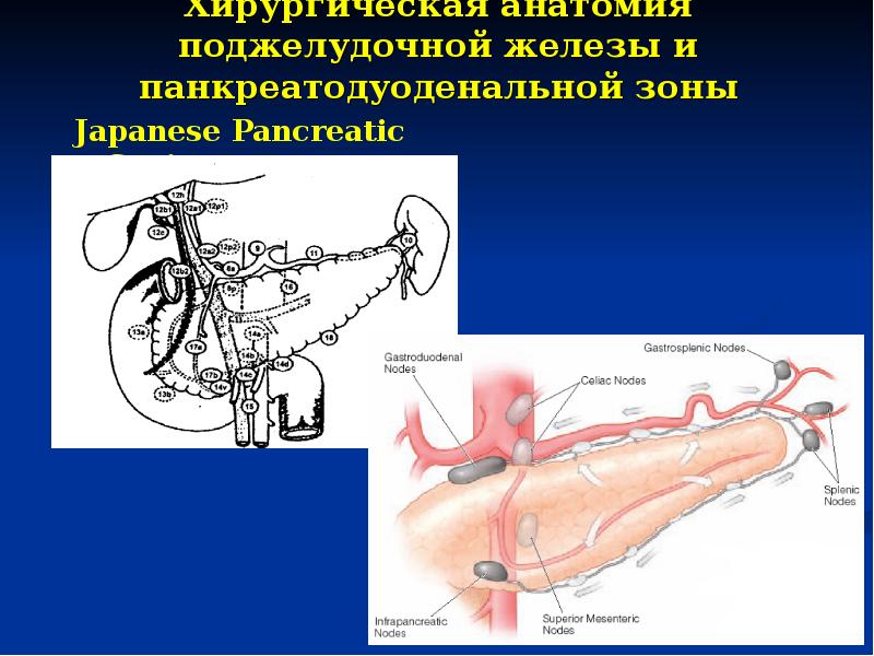 Панкреатодуоденальная резекция схема операции