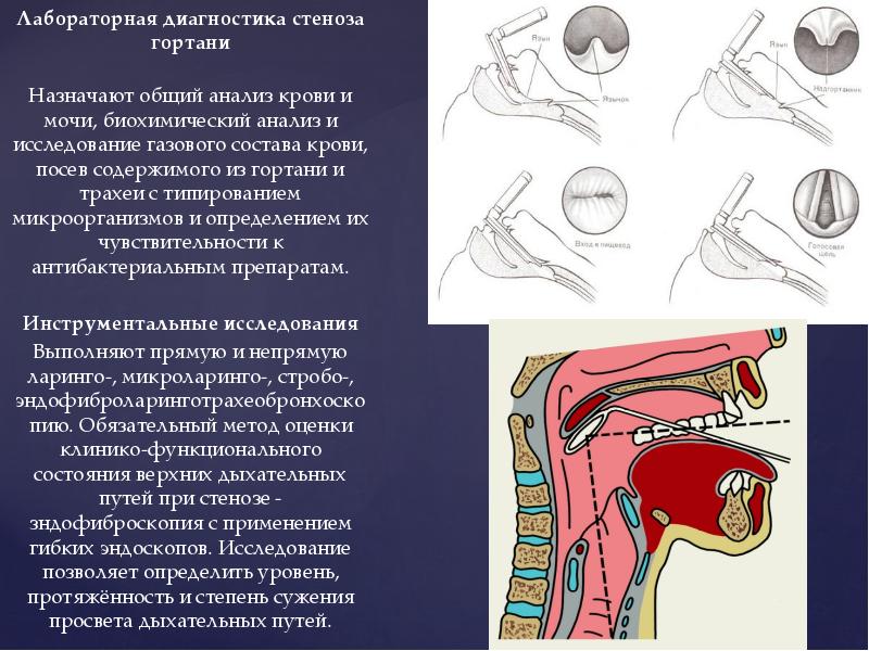 Острый и хронический стеноз гортани презентация