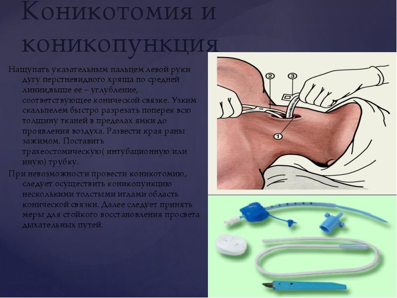 Острый и хронический стеноз гортани презентация