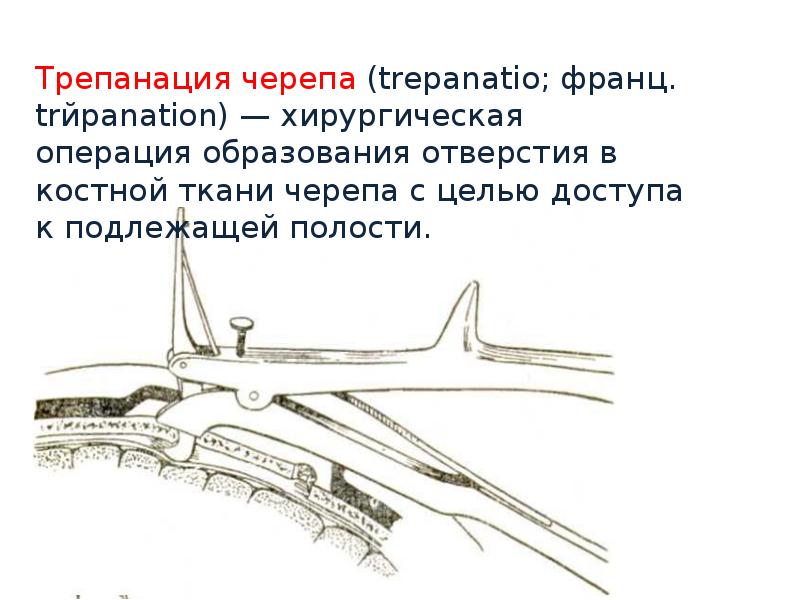 Трепанация по вагнеру. Костно-пластическая Трепанация. Костно-пластическая и Декомпрессивная Трепанация черепа. Техника выполнения резекционной трепанации черепа.. Костно пластическая и декомпрессионная Трепанация черепа.