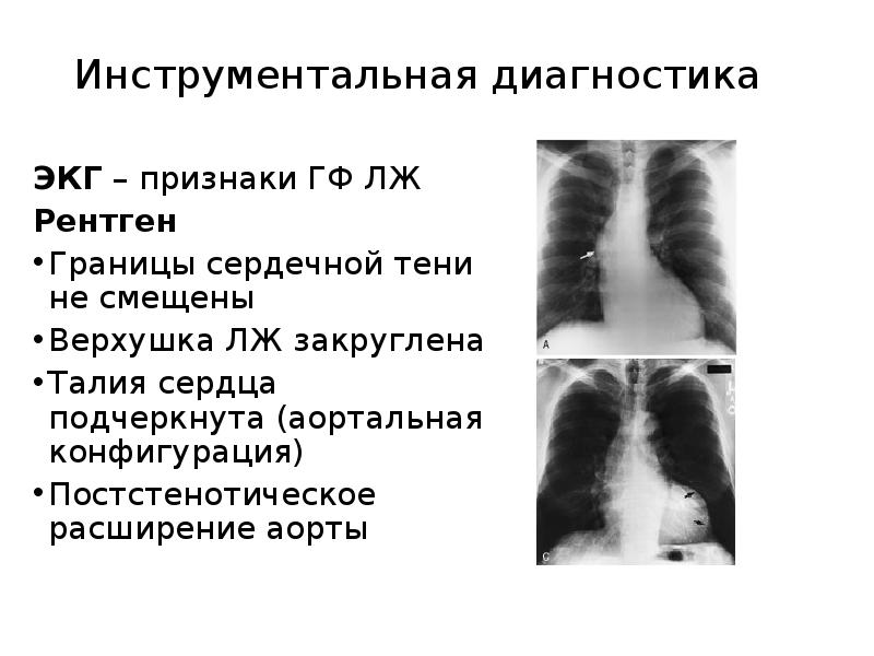 Границы расширены влево. Расширение аорты рентген. Расширение тени сердца рентген. Границы сердца расширены на рентгене.