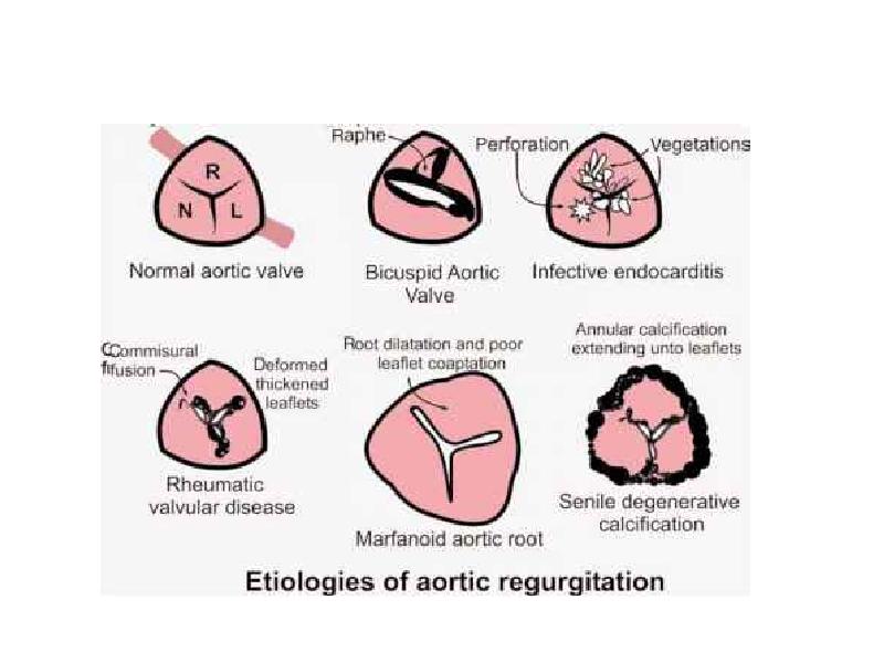 Аортальные пороки сердца картинки