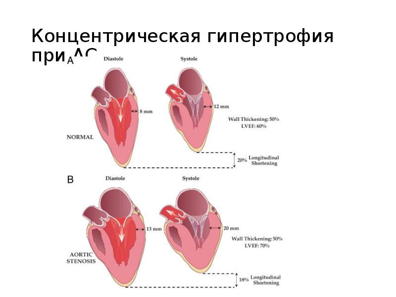 Презентация гипертрофия миокарда