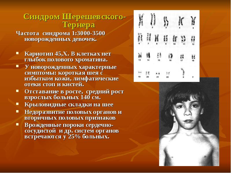 Синдром шерешевского тернера презентация по генетике