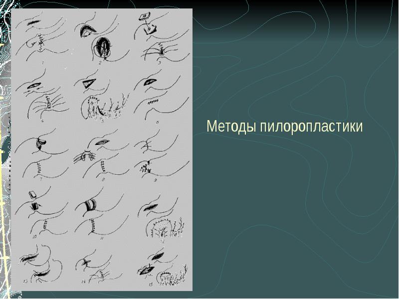 Язвенная болезнь 12 перстной кишки скачать презентацию