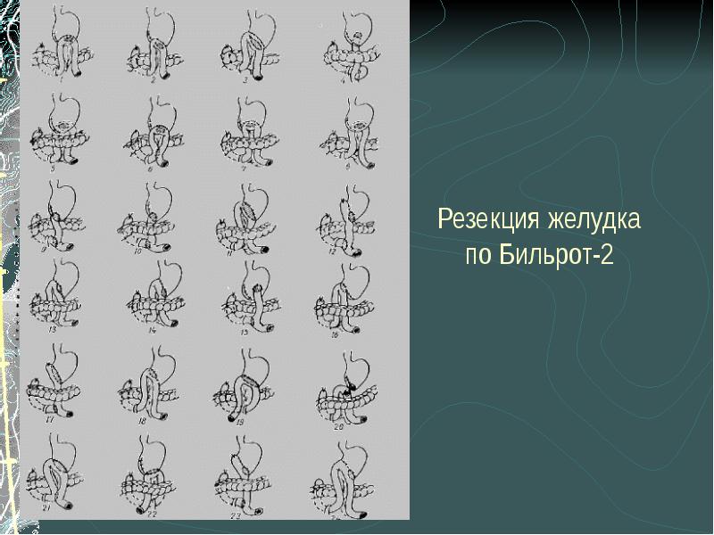 Язвенная болезнь 12 перстной кишки скачать презентацию