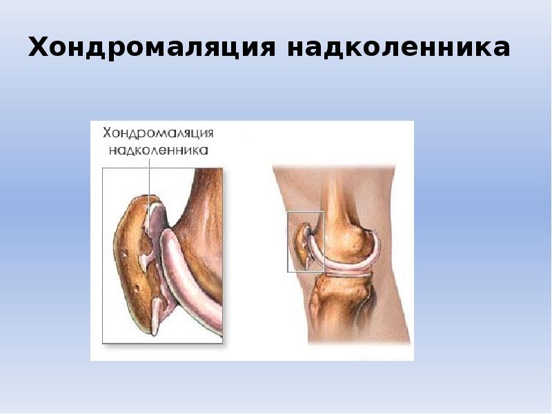 Хондромаляция надколенника надколенника. Хондромаляция надколенника 2-3 степени. Болевой синдром надколенника. Хондромаляция надколенника 2 степени. Хондромаляция бедренной кости.