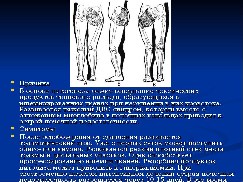 Презентация по травматологии на тему синдром длительного сдавления