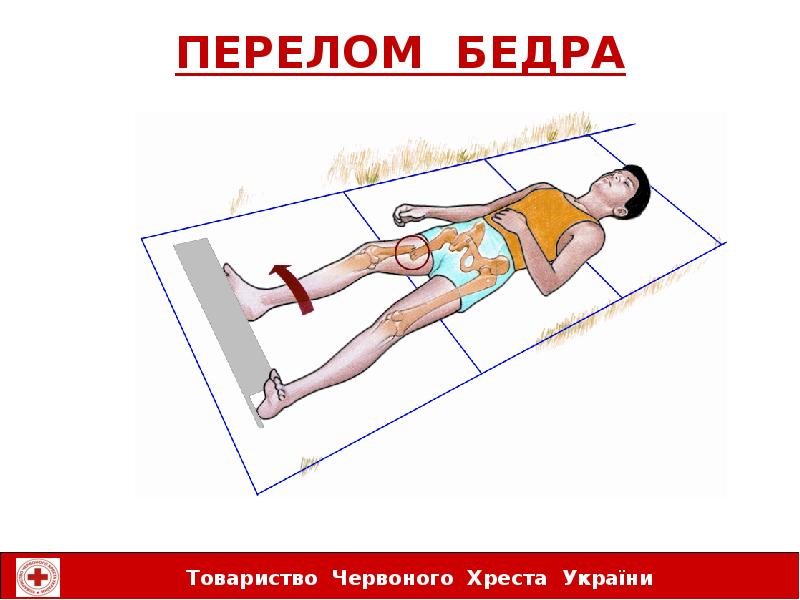 гимнастика для лежачих больных с переломом бедра. перелом бедра гипсование. кровать после операции на тазобедренном суставе. сиденье-туалет для больных. туалет перелом бедра.