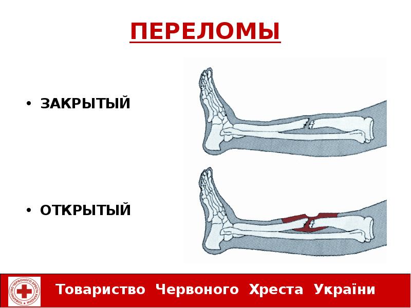 Перелом картинки для презентации