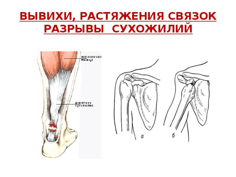 Растяжение связок работа. Растяжения и разрывы связок и сухожилий. Разрывы, растяжение мышц и сухожилий.