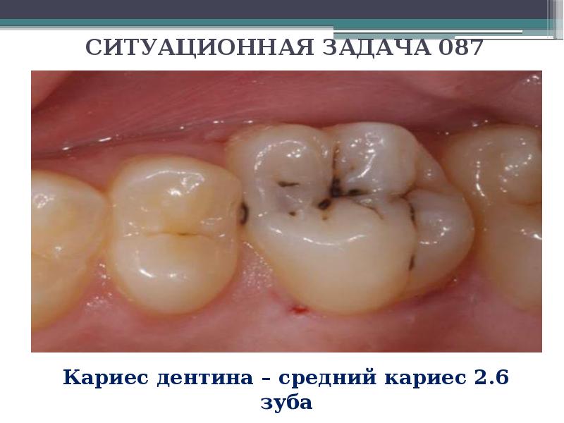 Кривая стефана в стоматологии презентация